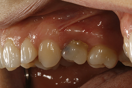 Implant dent - Avant